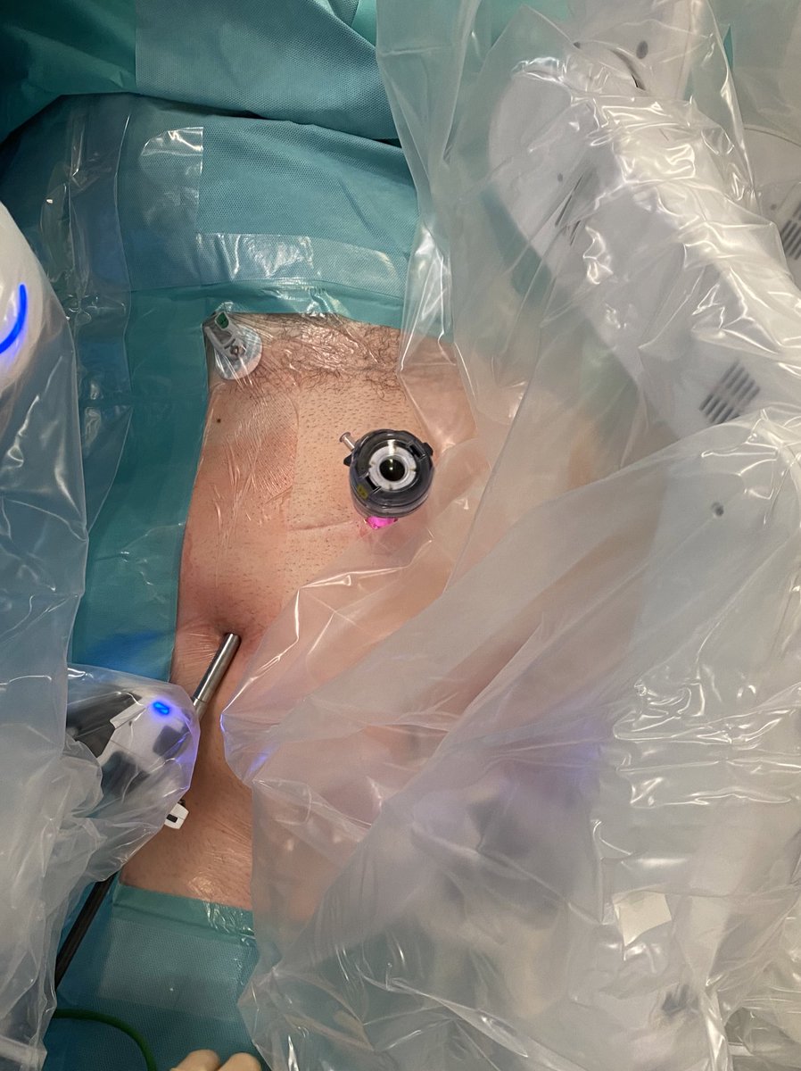 Hbp_EgLleida's tweet photo. VI-VIIcolorectal metastasis:robotic parenchymal-sparing hepatectomy/ICG24h before surgery/20degrees left tilt position/auxiliary port btw 1 and 2 forCUSA transection. How about your approach? @HpbMar @IelpoB @VMolina_82 @seccionhbpaec @fpa_que @hpb_so @santiazagra @Cesar_Ginesta https://t.co/NKAhMwbBq9