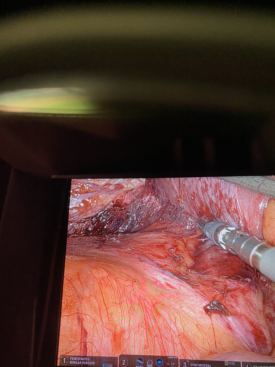 VI-VIIcolorectal metastasis:robotic parenchymal-sparing hepatectomy/ICG24h before surgery/20degrees left tilt position/auxiliary port btw 1 and 2 forCUSA transection. How about your approach? <a href="/HpbMar/">HPB unit Hospital del Mar</a> <a href="/IelpoB/">benedetto ielpo</a> @VMolina_82 @seccionhbpaec <a href="/fpa_que/">FPardo</a> <a href="/hpb_so/">SoMe4HPB</a> <a href="/santiazagra/">Juan Santiago Azagra</a> <a href="/Cesar_Ginesta/">Cesar Ginestà</a>