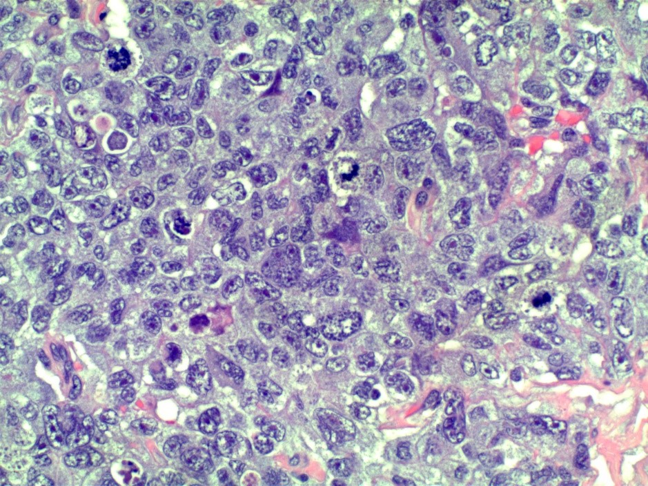 A 20 YO male with a unilateral testicular mass. 

Case provided by Husam Jum'ah (@jumah_husam)
#Gupath #Uropath #Pathology #Pathtwitter #Urology