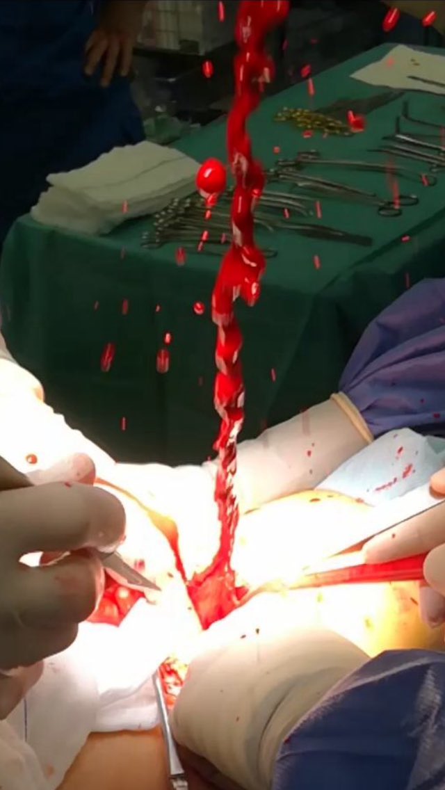 😱😱😱 Quick please!!! Look for the Vascular Surgeon!!!!!