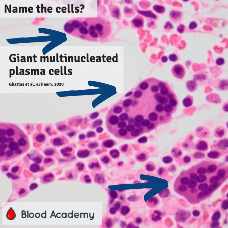 blood_academy's tweet photo. 1/ These are giant multinucleated plasma cells in relapsed plasma cell myeloma. By immunohistochemistry, they had positive staining for CD138, CD38, and CD56 and were lambda restricted. CD45 was negative. https://t.co/QJRd1MIpZa