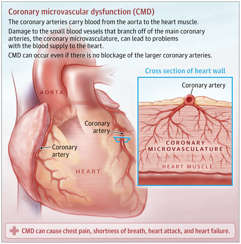 Epochal_Cell's tweet photo. Coronary microvascular dysfunction refers to abnormal dilation and constriction of the small blood vessels in the heart. https://t.co/JDGczXg0ki