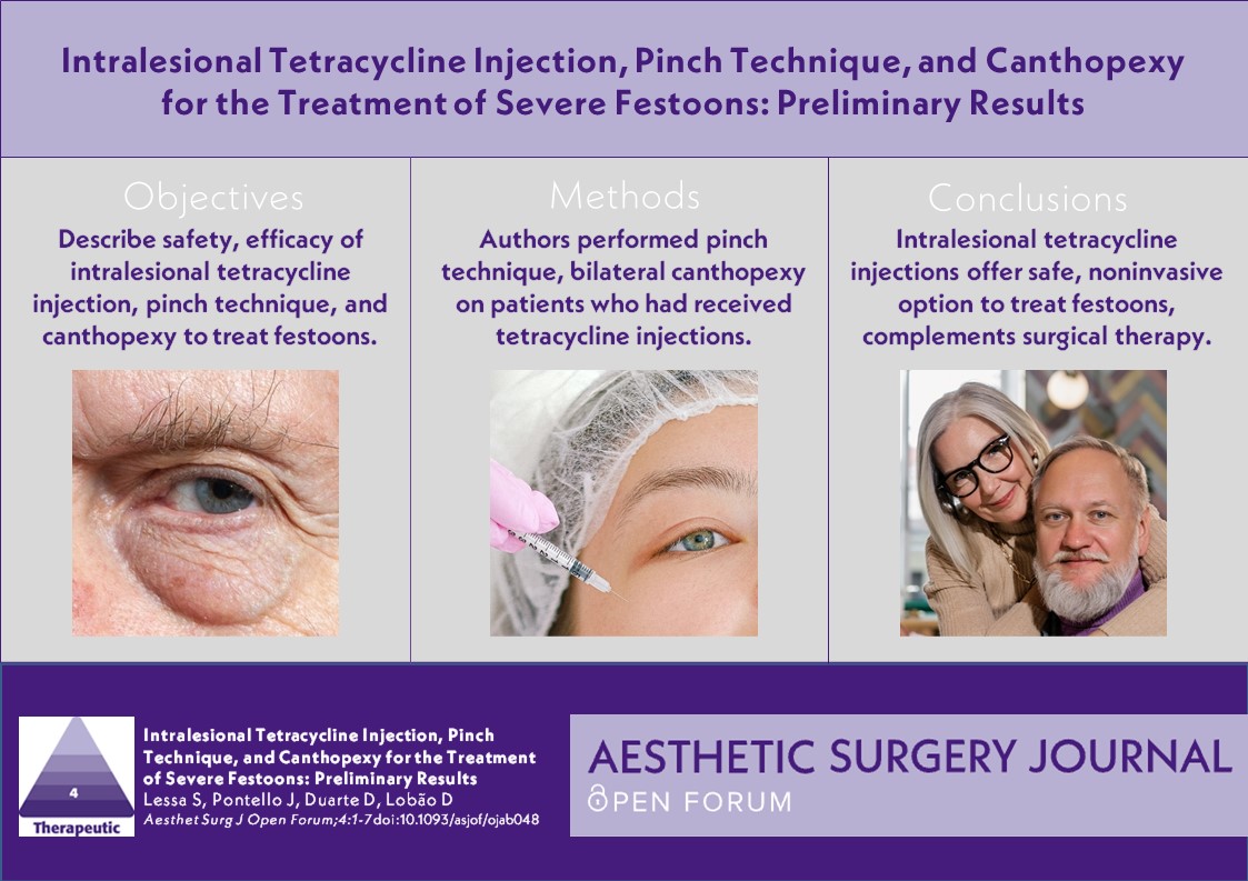 Could #tetracycline become the dominant technique for treating #lowereyelid #festoons? Read the article &amp; <a href="/drpacella/">Salvatore Pacella MD</a>'s commentary in #ASJOpenForum here: bit.ly/3I4Kwo0 + bit.ly/3LQNwXw

<a href="/GabiMiottoMD/">Gabriele Miotto MD</a>
<a href="/drorentepper/">Dr Oren Tepper</a>
<a href="/NahaiDr/">Dr Nahai</a>
<a href="/drkenkel/">Jeffrey Kenkel, MD</a>
<a href="/TheAestheticSoc/">The Aesthetic Society</a>
<a href="/drroykim/">Roy Kim 🇺🇸</a>