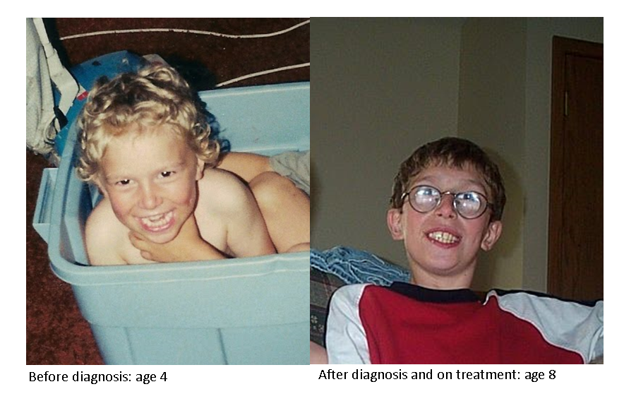 HCUAmerica's tweet photo. #RareDiseaseDay Fact 22: Classical #Homocystinuria Patients who are diagnosed late or off diet can have very fair skin and hair. After becoming compliant with diet, multiple incidences of hair color darkening have been reported.
#ShowYourStripes #ItsInMyGenes https://t.co/eFExWZ9SEz