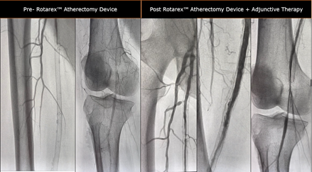 TimHugBD's tweet photo. In-Stent Restenosis case treated by Dr. Varti with the #Rotarex Atherectomy Device. #RemoveWithRotarex System

Not for use in the cardiopulmonary, coronary, carotid, cerebral, renal or venous vasculature. Safety info: https://t.co/IgH6UqVC8N https://t.co/ippRzOdO3B