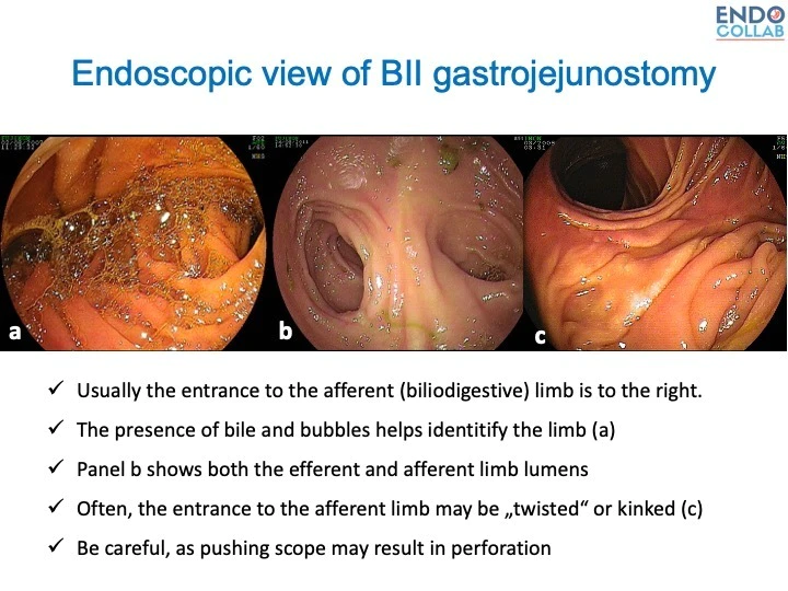 EndoCollabcom's tweet photo. Endoscopic View of BII Gastrojejunostomy https://t.co/qUNSPRNuwm