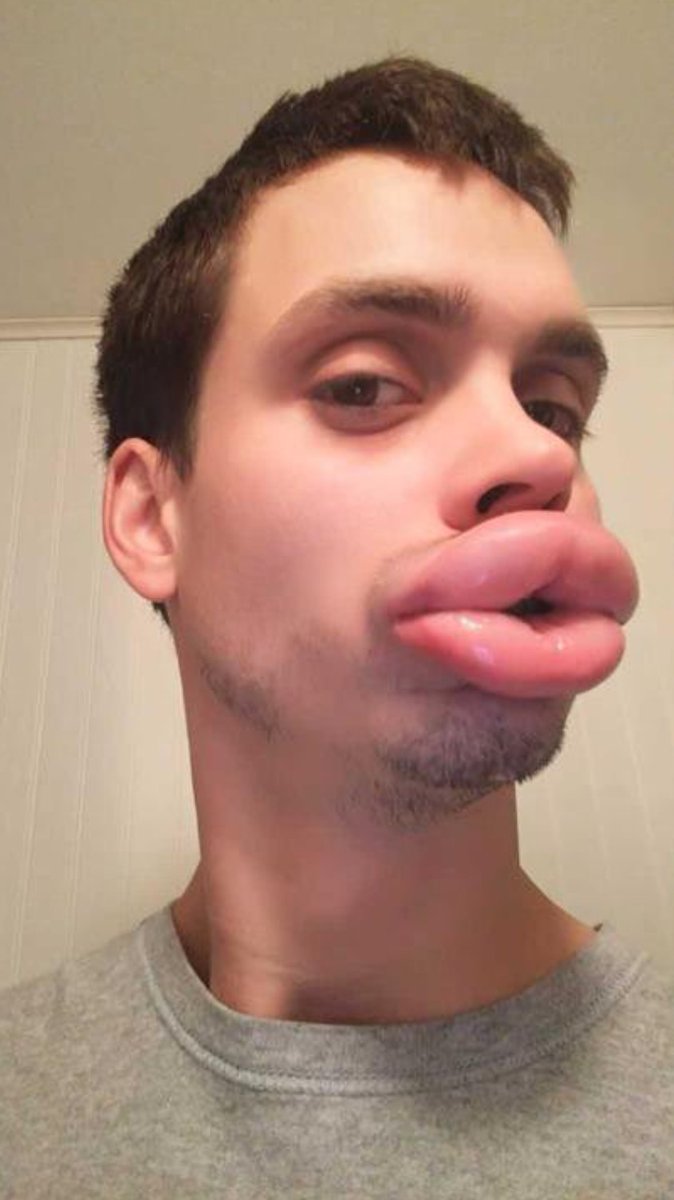 fakemenlover's tweet photo. THIS IS A REQUEST.
Does anybody knows who this angel is, if he's on twitter or any other platform? If I can reach him somehow? I only would like to express him my admiration for his lip pumping 🤩
#biglips #lippumping #lipfiller #malelips https://t.co/fDoFIzzybw