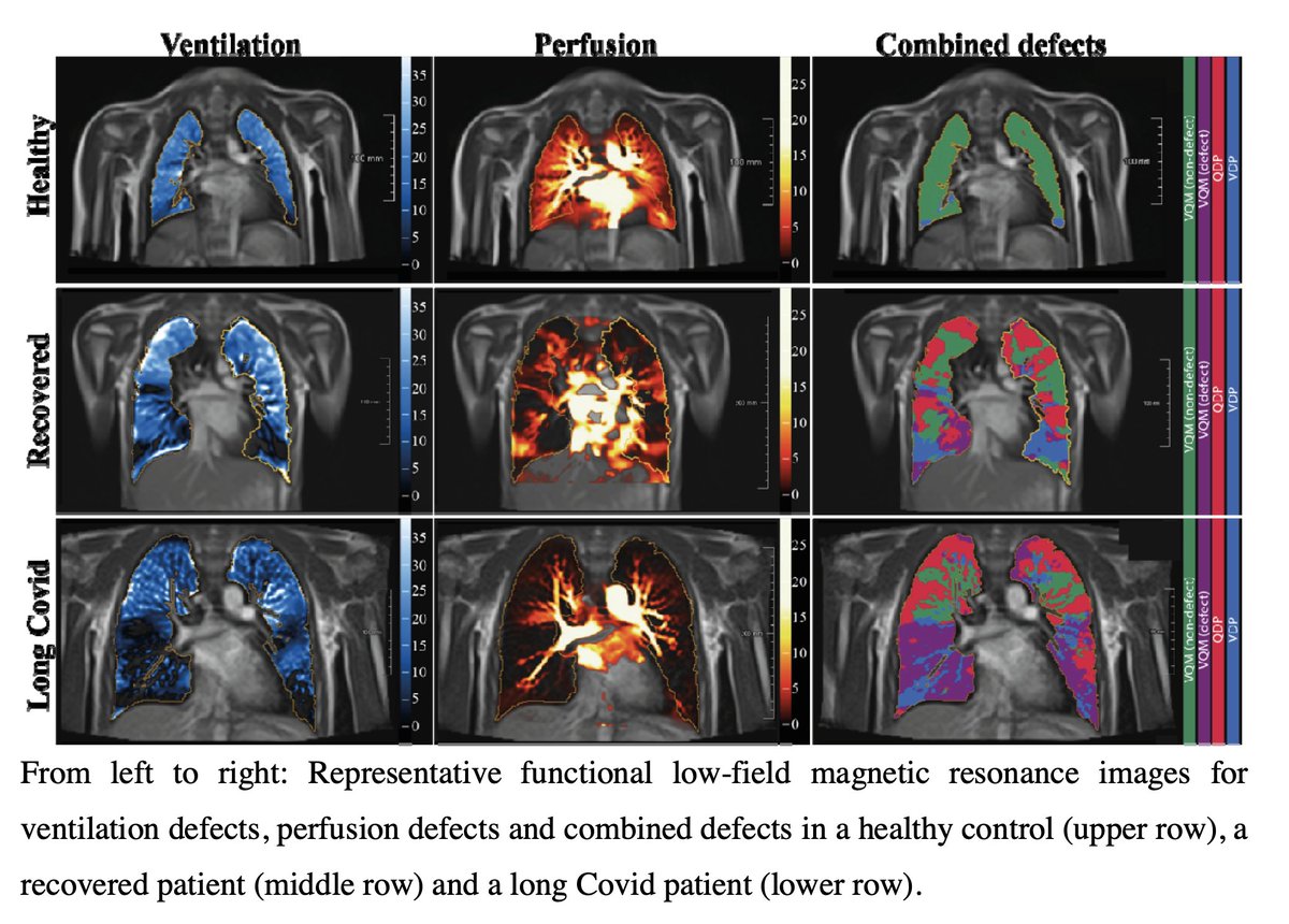 Study: Lung injury in children after Covid:

Changes in lungs of children&amp;adolescents 5-&lt;18 years after Covid infection showing widespread ventilation, perfusion and combined ventilation/perfusion defects compared to healthy children. 1/ 

medrxiv.org/content/10.110…