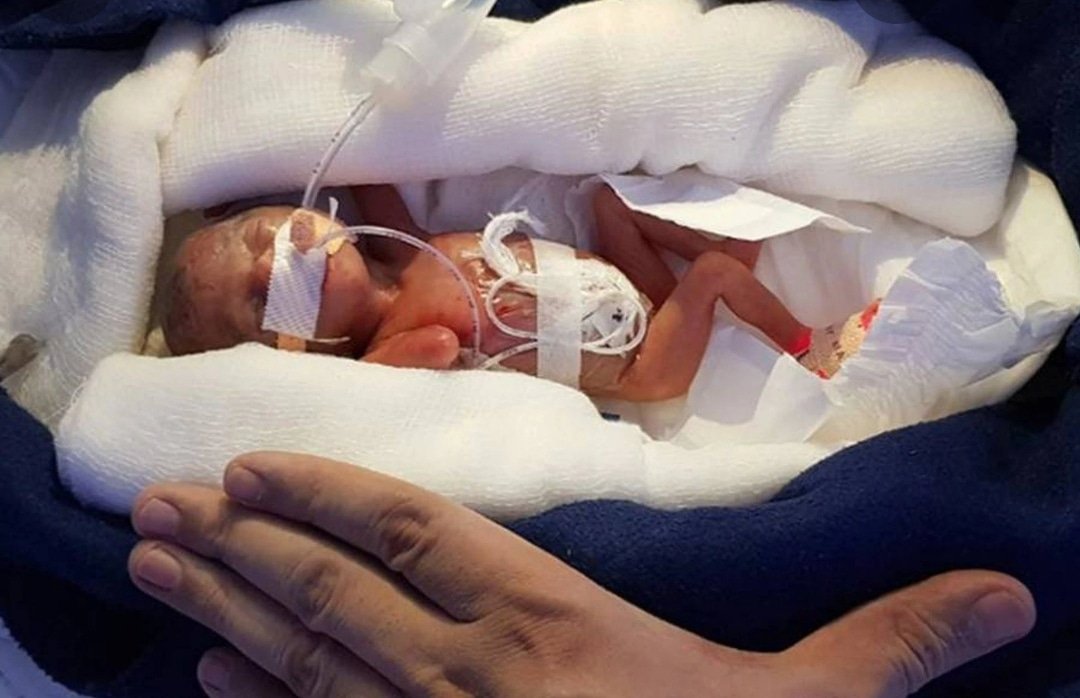 MNFamilia's tweet photo. Una niña totalmente sana que ahora tiene tres años, podría ser la recién nacida prematura y superviviente más joven del mundo. Nació con tan solo 21 semanas y cuatro días de gestación (menos de cinco meses), según publicó hace unos días el Journal of Pediatrics.
#SiALaVida https://t.co/4VgIJFNfsu