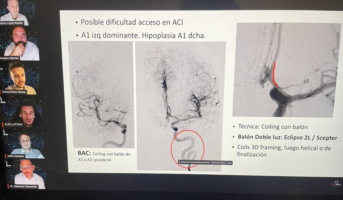 Isa (@isarcaamano) on Twitter photo El combine de hoy , con nuestro panel de expertos discutiendo el abordaje de aneurismas por vía endovascular vs Cx ! <a href="/Alex_Luttich/">Alex Interventional NeuroRx</a> <a href="/AntonioLR81/">Antonio López-Rueda</a> <a href="/Justcharly9/">Carlos Pérez García</a> <a href="/marianitowerner/">mariano werner</a> <a href="/atomasell/">Alejandro Tomasello W</a> <a href="/ComBINEurovasc/">ComBINE</a> El combine de hoy , con nuestro panel de expertos discutiendo el abordaje de aneurismas por vía endovascular vs Cx ! <a href="/Alex_Luttich/">Alex Interventional NeuroRx</a> <a href="/AntonioLR81/">Antonio López-Rueda</a> <a href="/Justcharly9/">Carlos Pérez García</a> <a href="/marianitowerner/">mariano werner</a> <a href="/atomasell/">Alejandro Tomasello W</a> <a href="/ComBINEurovasc/">ComBINE</a>