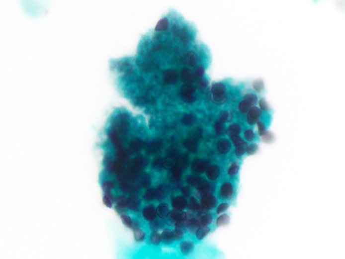 BAL w/ the characteristic foamy proteinaceous casts seen w/ Pneumocystis jirovecii. The organisms may appear as negative images on pap staining which are then highlighted w/ GMS stain where they appear cup-shaped +/- a central dark zone 👀👀👀

#CytoPath #PathTwitter