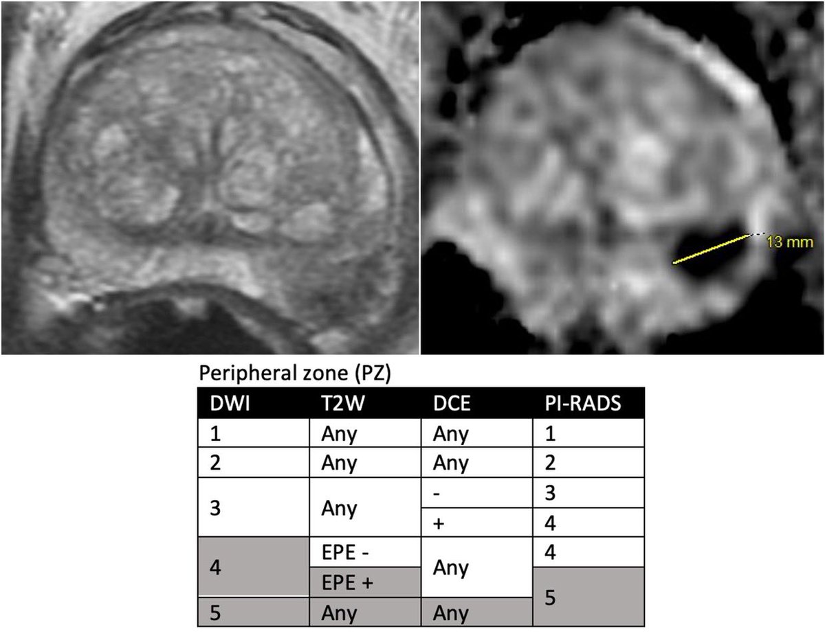 Iztok Caglic (@iztokcaglic) on Twitter photo PI-RADS 4 or PI-RADS 5? #MRI #prostatecancer <a href="/Tristan_Radiol/">Tristan Barrett</a> <a href="/radiolobt/">Baris Turkbey MD</a> <a href="/ProfPadhani/">Anwar Padhani</a> <a href="/VPanebiancoIT/">Valeria Panebianco</a> <a href="/JelleBarentsz/">Jelle Barentsz</a> PI-RADS 4 or PI-RADS 5? #MRI #prostatecancer <a href="/Tristan_Radiol/">Tristan Barrett</a> <a href="/radiolobt/">Baris Turkbey MD</a> <a href="/ProfPadhani/">Anwar Padhani</a> <a href="/VPanebiancoIT/">Valeria Panebianco</a> <a href="/JelleBarentsz/">Jelle Barentsz</a>