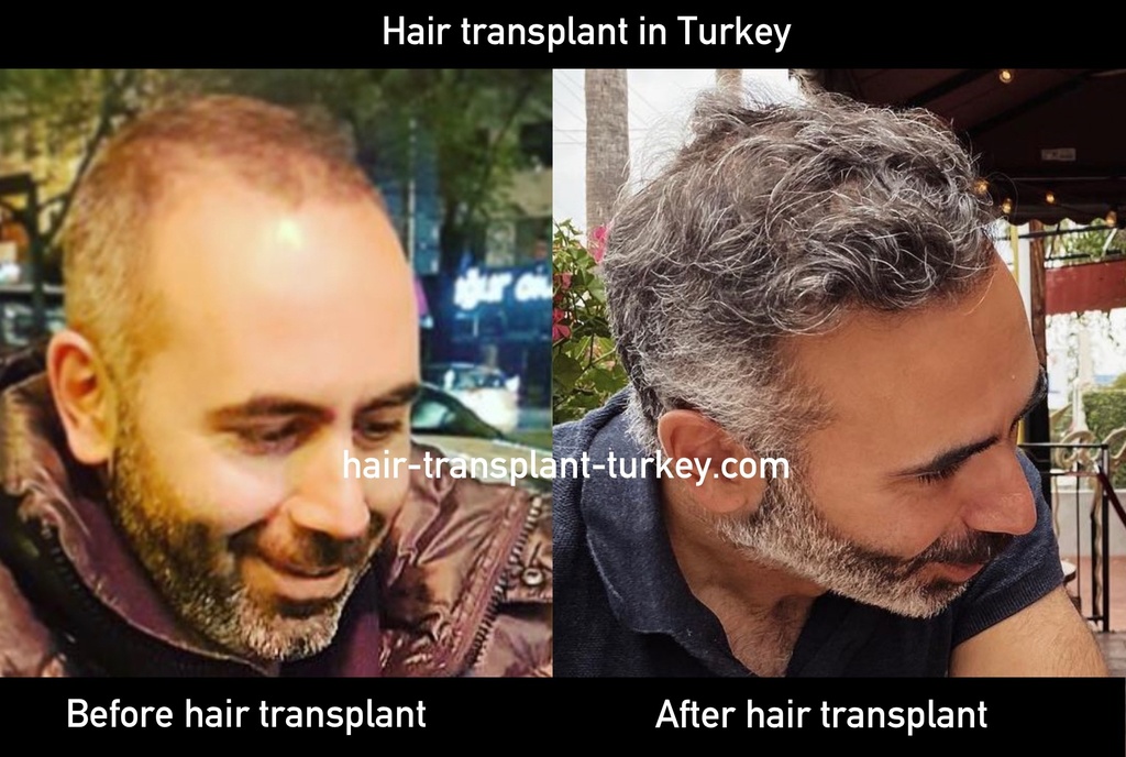 Hair Transplant in Turkey Cost Packages | Hair Clinic Turkey/Istanbul