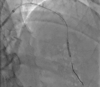 CathLabDigest's tweet photo. Read the latest from CLD’s #CalciumCorner:
Management of Calcified Lesions in Hospitals Without Surgical Backup
B. Clay Sizemore, MD
@ShockwaveIVL #cardiotwitter
https://t.co/xaDuDvlZ1U https://t.co/cYqEysGMJI