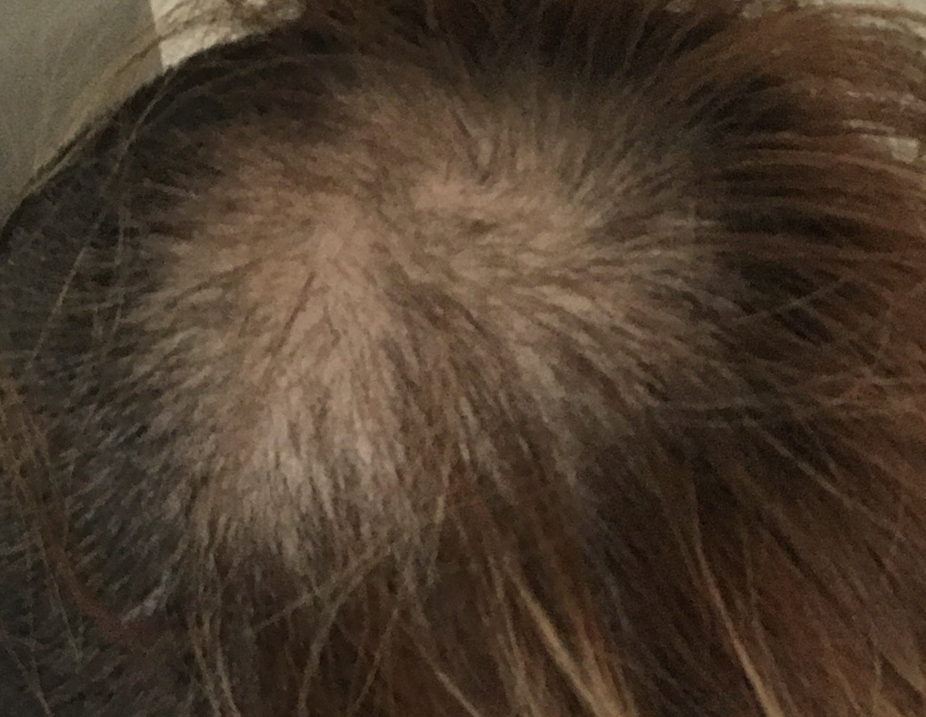 薄毛からのサクセスストーリ Usugefukkatsu Twitter