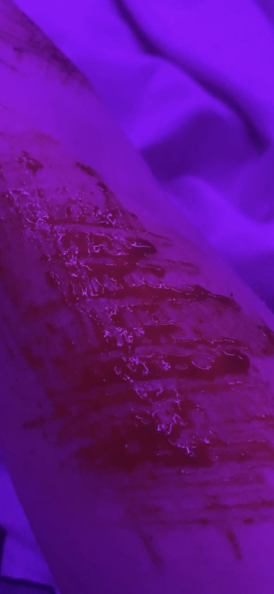 777missangel's tweet photo. blood! #shtwt #madeofstyro #catscratches #shtwt https://t.co/W4OnSRYzlJ
