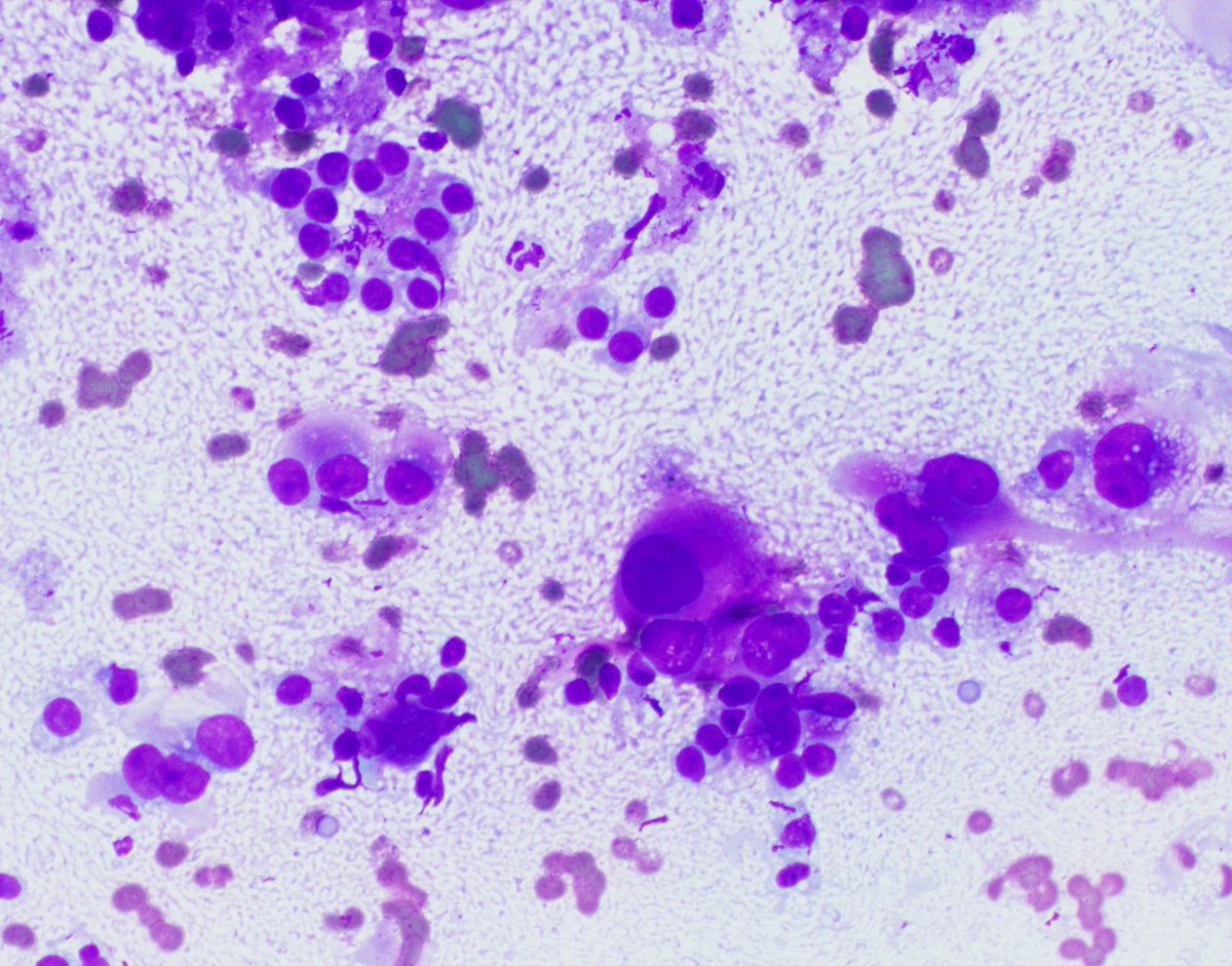 HubertLauMD's tweet image. Lung nodule biopsy. What is your favored diagnosis? 🐯 #CytoPath #FNApath