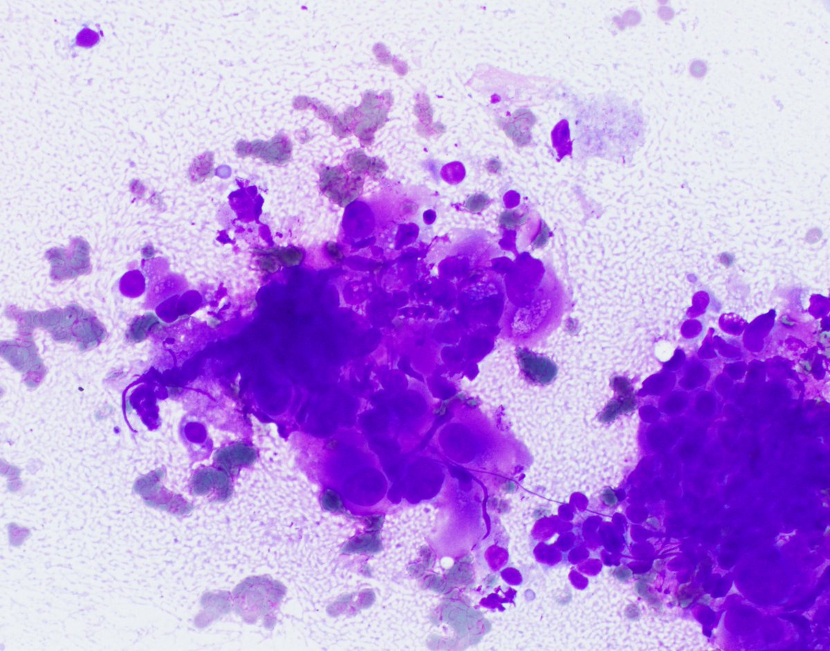 HubertLauMD's tweet image. Lung nodule biopsy. What is your favored diagnosis? 🐯 #CytoPath #FNApath