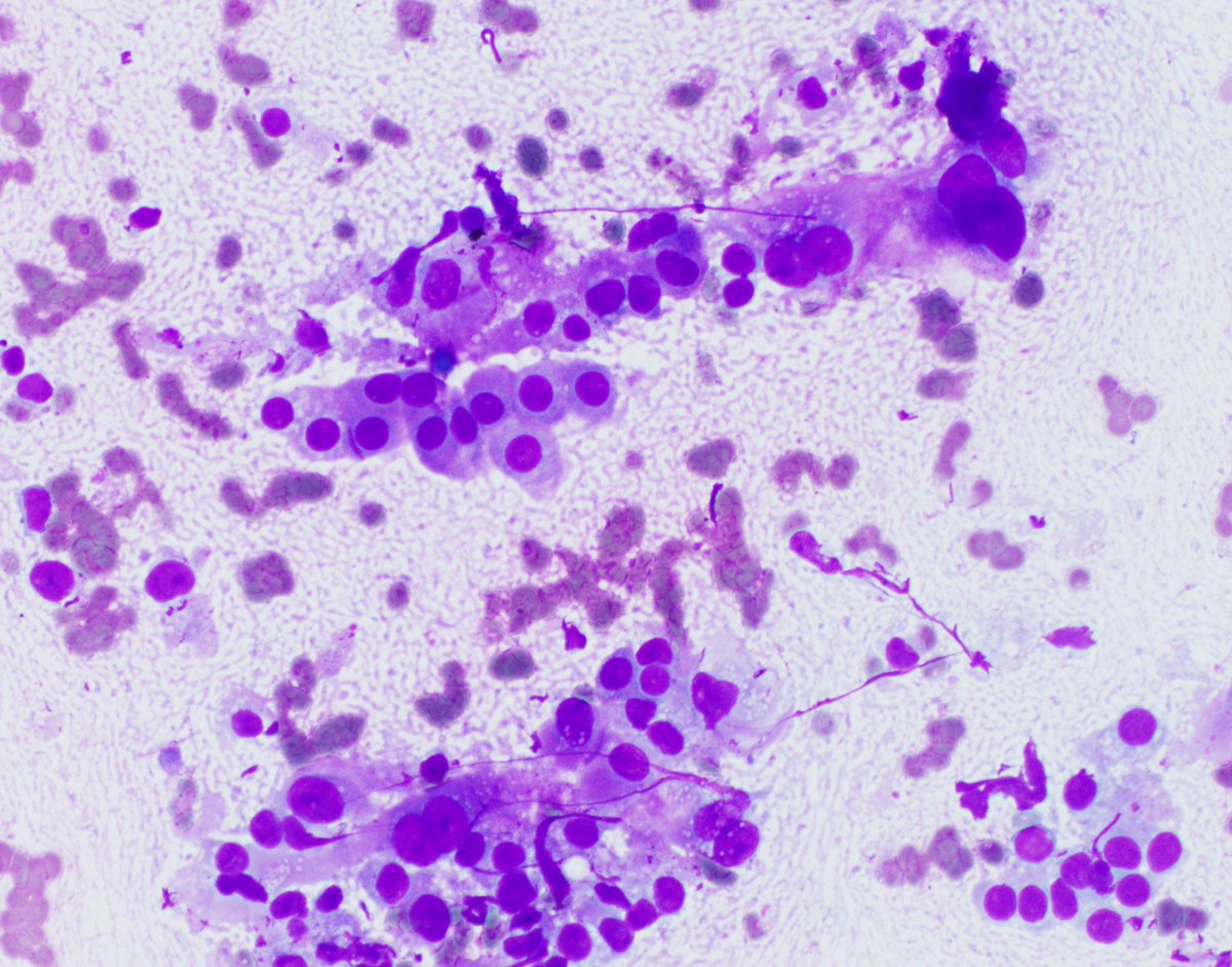 HubertLauMD's tweet image. Lung nodule biopsy. What is your favored diagnosis? 🐯 #CytoPath #FNApath