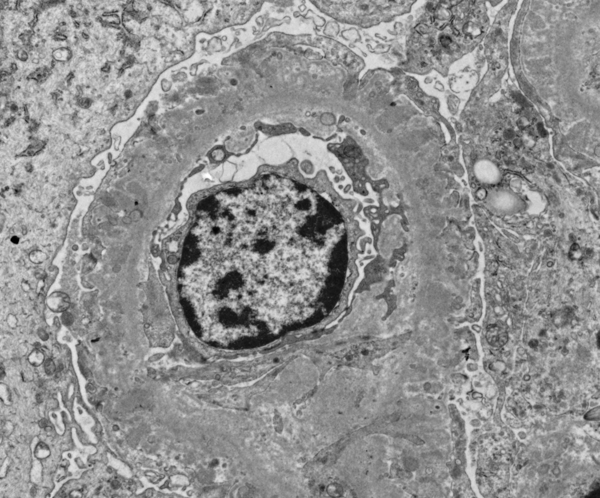 Big disease, little person: 9 yo M w/ steroid resistant nephrotic syndrome. Surprise: PLA2R positive membranous nephropathy in the youngest patient I've seen so far. EM revealed Stage III (incorporated/resorbing) GBM deposits = been going on for a while. It wasn't minimal change!