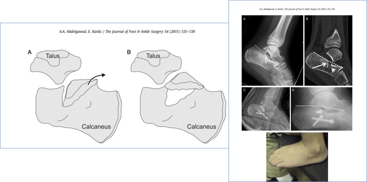 Calcaneus fractures are rare in children, and when they happen, they are usually minimally displaced and do not need surgery. Rarely, you may encounter ones that require elevation of the articular surface. Sinus tarsi approach is optimum in these cases. https://t.co/Es79WisszL https://t.co/EP8McBrzIF