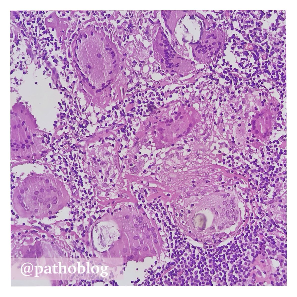 pathoblog's tweet photo. Giant cell with Schaumann body in sarcoid granuloma.
#pathoblog #pathology #pathtwitter #pulmpath #pathresidents https://t.co/lJWciJ0udC