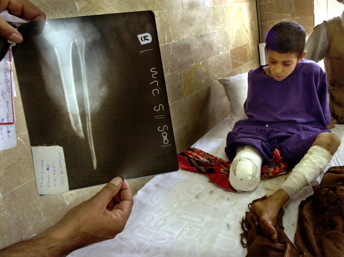 hersaattarih's tweet photo. Röntgende 10 yaşındaki Sath Mohammad'ın parçalanmış bacağı görül��yor. O ve küçük kız kardeşi Afganistan'ın Kandahar kentindeki evlerinin yakınında yürürken ABD uçağından bir füze yolda patladı (6 Kasım 2001) [2160x1619] - #2160x1619 #ABD #Afganistanın #bacağı #bir #evlerinin ... https://t.co/20nVFIBHeZ