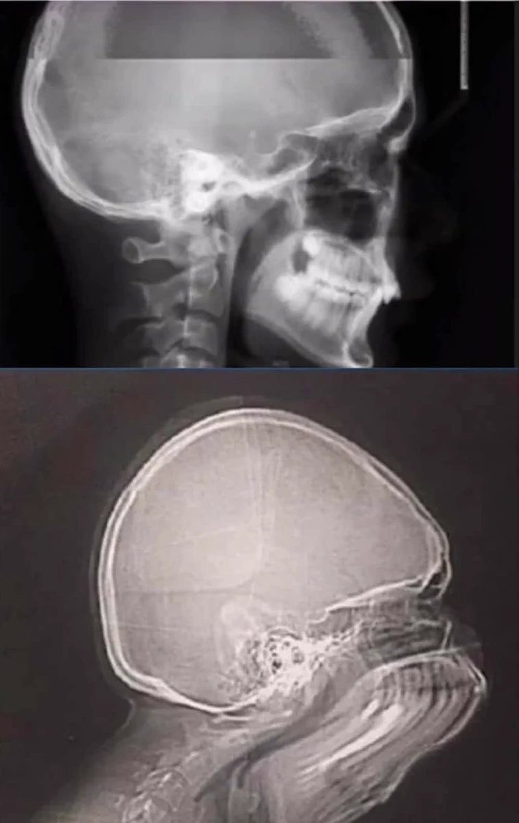 レントゲンの撮影中に？くしゃみをしたらこうなるwww