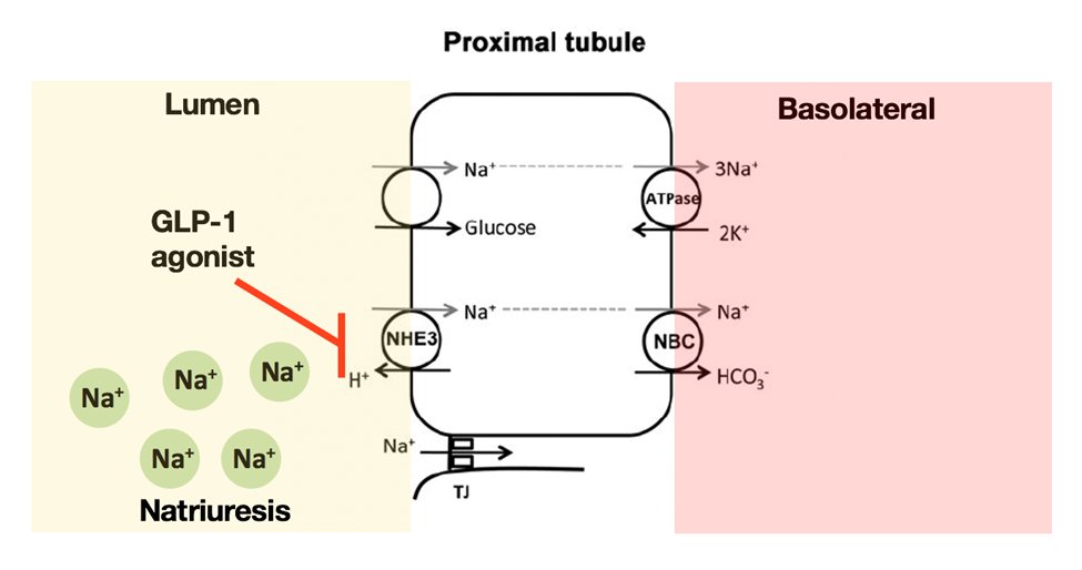 29) Did you mark C?
In fact, #GLP-1 agonists reduce phosphorylation of renal cortical Na+/H+ exchanger isotope 3 (NHE3) antiporter, which correlates with NHE3 reduced transport activity in the proximal tubule and resultant natriuresis.
🔓journals.physiology.org/doi/full/10.11…