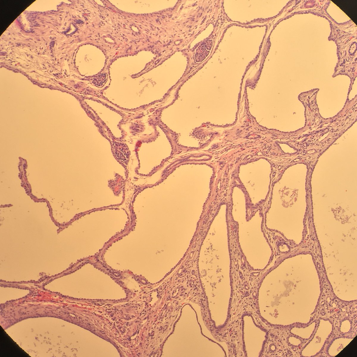 megothelioma's tweet photo. Wow, I almost wouldn't have known this was a kidney, but some shriveled glomeruli gave it away. This is a case of autosomal recessive polycystic kidney disease in a <1 month old baby. #PathTwitter #PediPath https://t.co/8xp82xqJTk