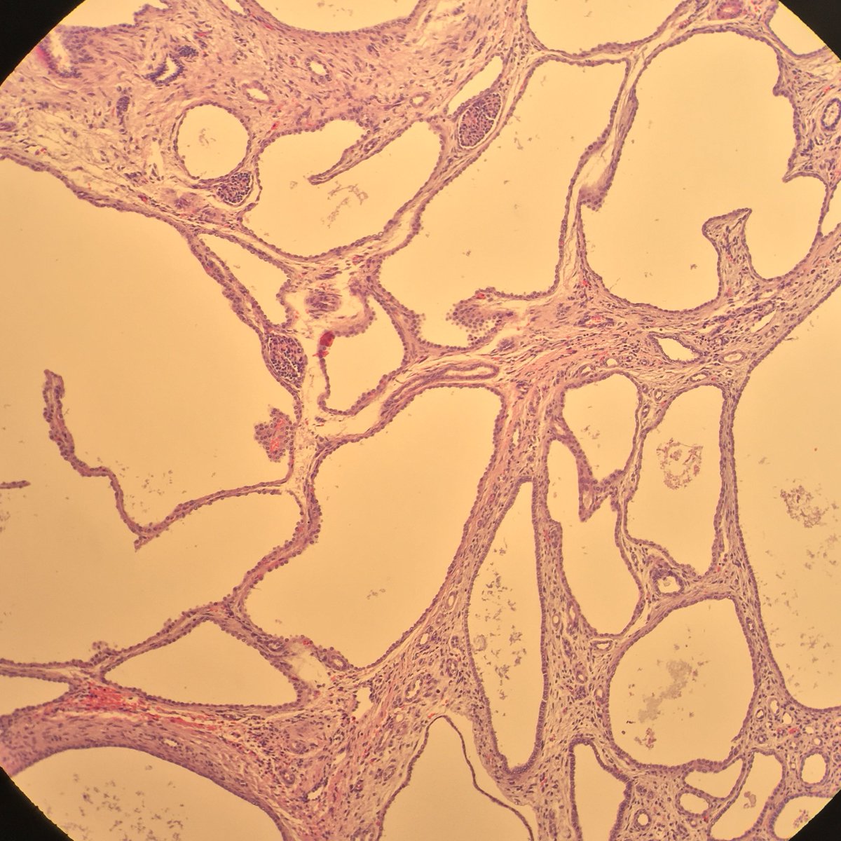 Wow, I almost wouldn't have known this was a kidney, but some shriveled glomeruli gave it away. This is a case of autosomal recessive polycystic kidney disease in a <1 month old baby. #PathTwitter #PediPath