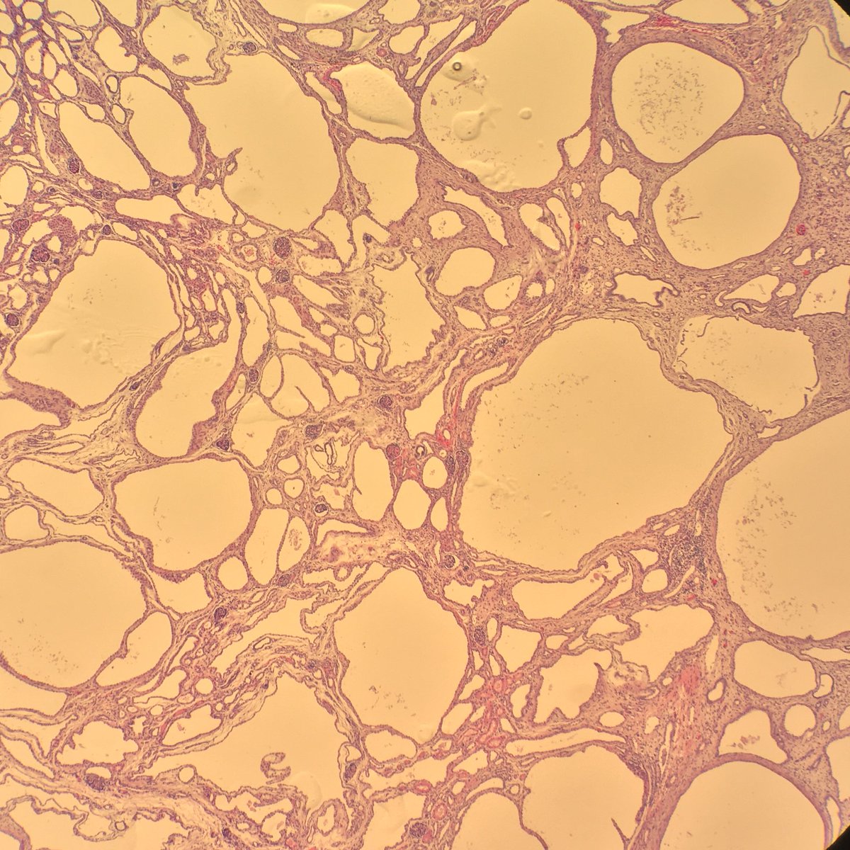 megothelioma's tweet photo. Wow, I almost wouldn't have known this was a kidney, but some shriveled glomeruli gave it away. This is a case of autosomal recessive polycystic kidney disease in a <1 month old baby. #PathTwitter #PediPath https://t.co/8xp82xqJTk