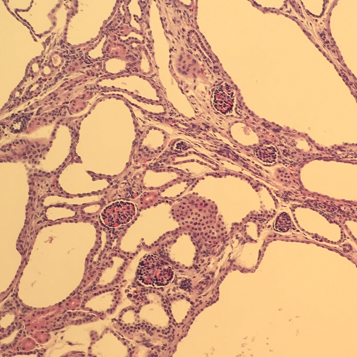 megothelioma's tweet photo. Wow, I almost wouldn't have known this was a kidney, but some shriveled glomeruli gave it away. This is a case of autosomal recessive polycystic kidney disease in a <1 month old baby. #PathTwitter #PediPath https://t.co/8xp82xqJTk