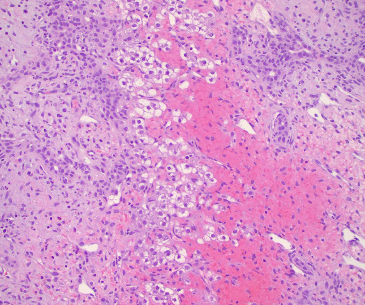 5 month old #livermass

🔹 Mesenchymal  hamartoma 🔹
🔬 Tortuous ductal structures, concentric collar of fibrous tissue, myxoid stroma
✨Assoc with 19q translocation 
✨Diffdx infantile hemangioma, undiff embryonal sarcoma
📄 Ref: pubmed.ncbi.nlm.nih.gov/28109716/
Contributed by @OsaeedMD
