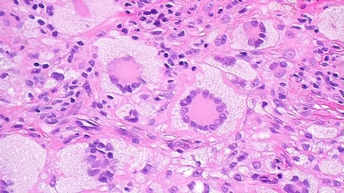 Yellow-red papule. Forehead of 5yo boy. One pic only. Your diagnosis? Answer &amp; 5 minute video here ➡️ kikoxp.com/posts/6846. #pathology #pathologists #pathTwitter #dermpath #dermatology #dermatologia #dermtwitter