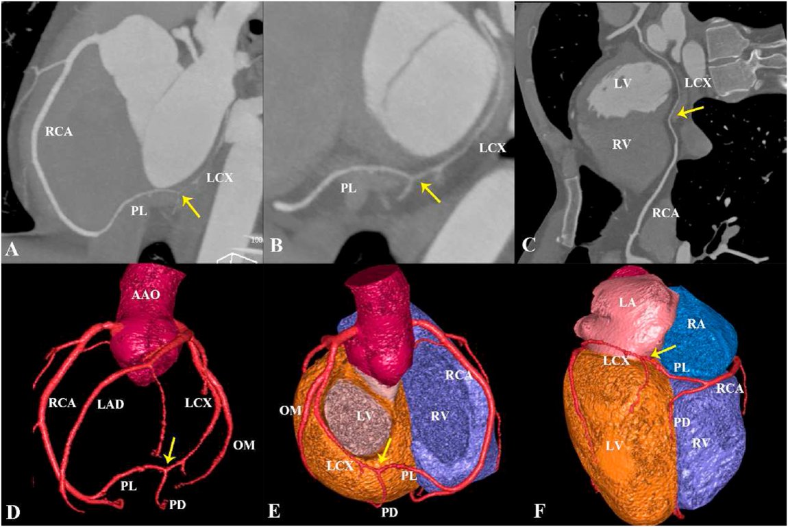 journalCCT's tweet image. Affecting only 0.002% of people, check out this exemplary case of a coronary arcade bridging the LCx and RCA demonstrated on #YesCCT

ow.ly/oi5150HZ1zs