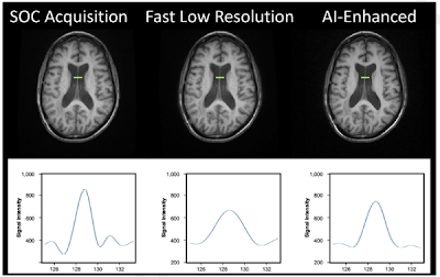 Radiology_AI's tweet photo. #Superresolution on 3D brain MRI sequences with 45% scan time reduction https://t.co/fxFRsa9irx @UCSFimaging @RadRudie @GregZ_MD #brainMRI #ML #MachineLearning https://t.co/m0V9FvpeFo