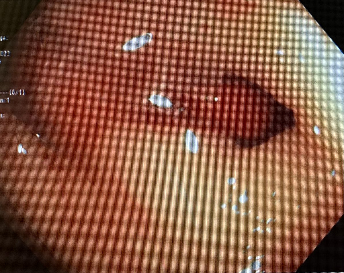 RoxyChis's tweet photo. This would have come in handy the other day #activelybleedingdiverticulum #overthescopeclip #combotherapy #GITwitter #MedTwitter #MedEd https://t.co/al94DKtabD