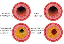 CADAwareness's tweet photo. Coronary artery disease, or CAD, is a condition that affects your heart. CAD is the most common heart disease in the US. CAD happens when coronary arteries have trouble supplying the heart with enough blood, oxygen, and nutrients. https://t.co/zL9OLdX01Z