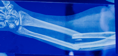 LaskerFDN's tweet photo. After trauma, bones sometimes need help to heal. Researchers show that local delivery of #mRNA encoding BMP-2 is sufficient to induce efficient bone healing in rats—without the adverse side effects of current treatments. @er_balmayor @MvanGriensven 
https://t.co/E5ZzI1XqrY https://t.co/tRpb0XP4TF