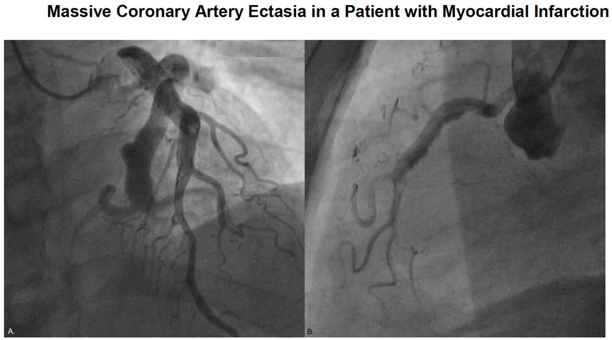 Coronary ectasia remains a treatment dilemma regarding revascularization strategy and anti-thrombotic treatment. Case reports suggest a possible role for OAC in event prevention.
Lack of RCTs➡️future research needed! 

#EHJACVC #cvacute #ACVC_ESC