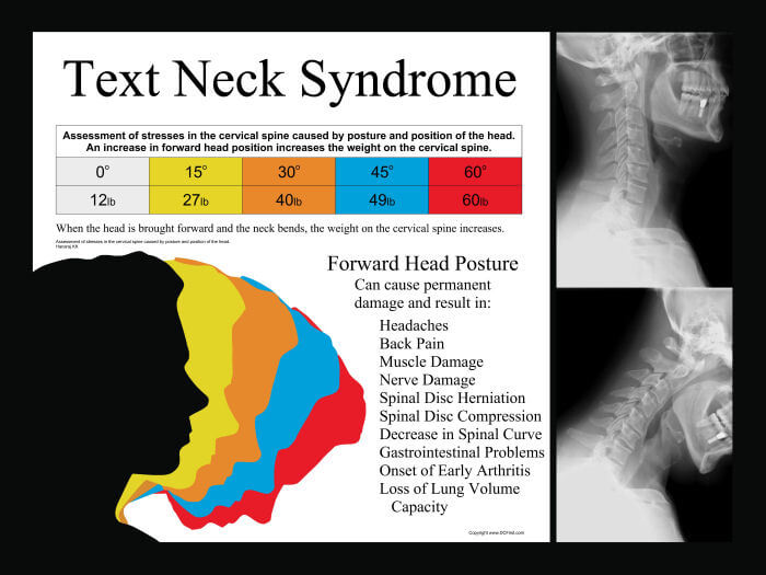 asterlingdc's tweet photo. Did you know that forward head posture aka “Text Neck” can cause early degeneration, muscle damage, disc herniations, disc compressions, nerve damage, as well as a variety of other conditions? If you want to know whether you have Text Neck, call us about our posture assessments! https://t.co/znBMC8W0TE