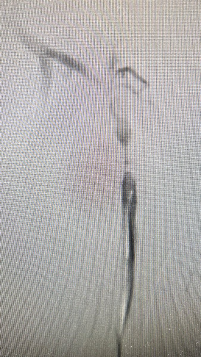 JHakmei's tweet photo. Follow up: patient had week pulse over inflow (left BCF). No thrill. @NMawlaMD @robshahverdyan @ASDINNews https://t.co/FHhOWPI3hy