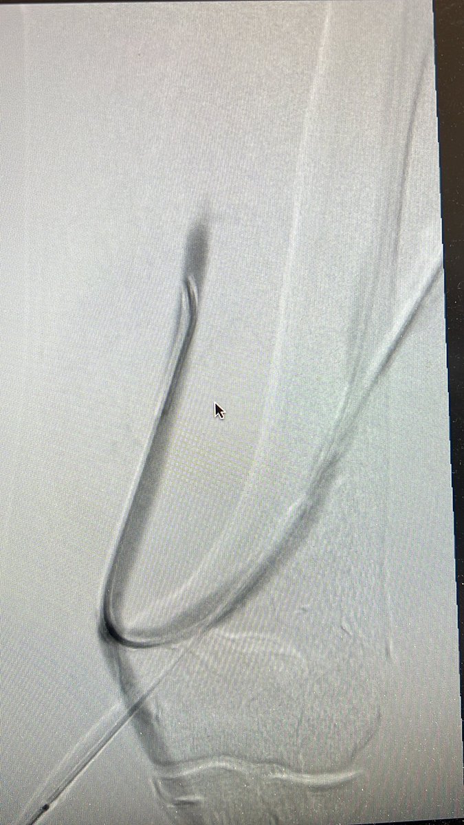 JHakmei's tweet photo. Results after angioplasty https://t.co/eTzyWLYgYf