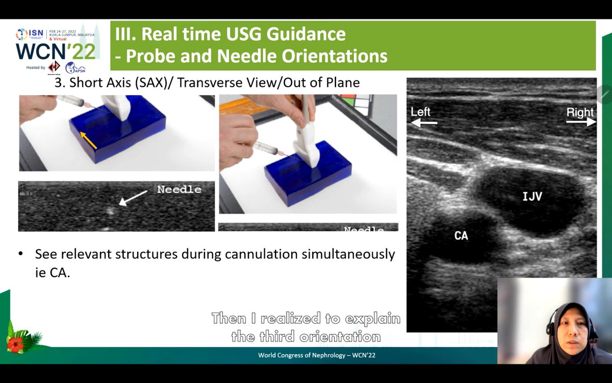 deniise_am's tweet photo. Probe and needle orientations:
1. Long axis
2. Oblique orientation
3. Short axis
#ISNWCN #POCUS #NephPocus https://t.co/9LbnFTBBPY