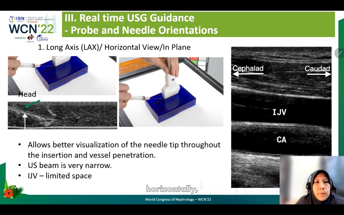 deniise_am's tweet photo. Probe and needle orientations:
1. Long axis
2. Oblique orientation
3. Short axis
#ISNWCN #POCUS #NephPocus https://t.co/9LbnFTBBPY
