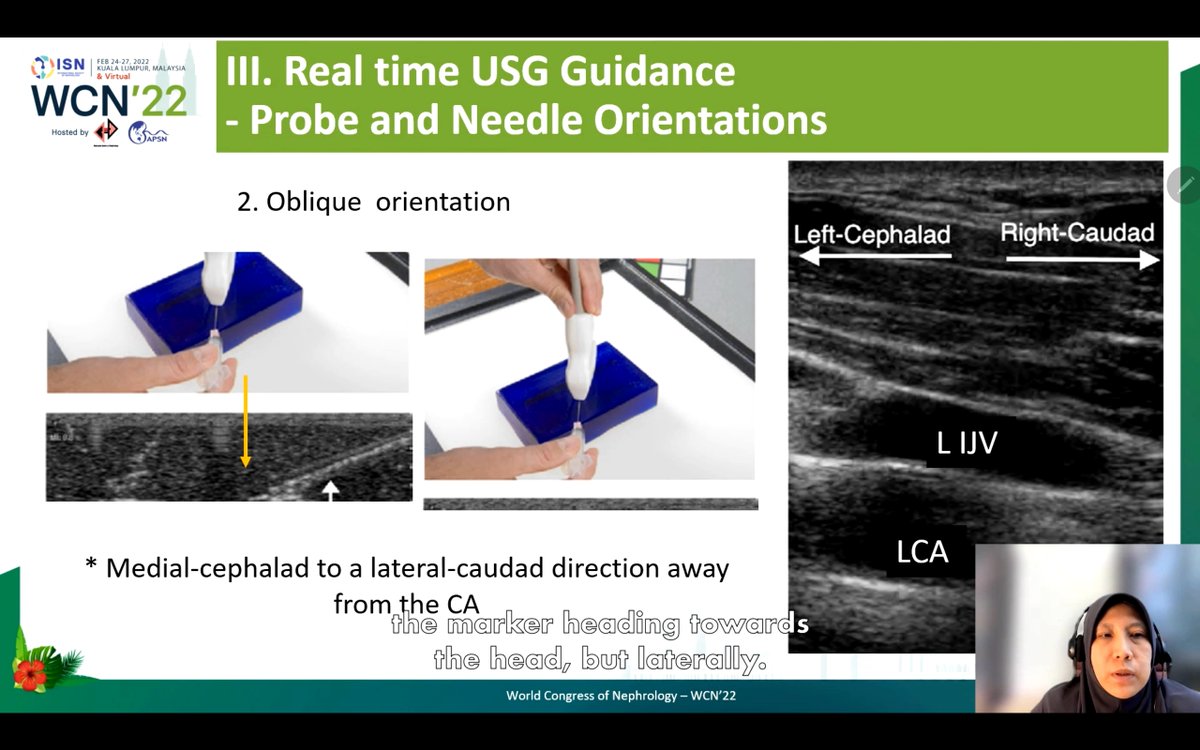 deniise_am's tweet photo. Probe and needle orientations:
1. Long axis
2. Oblique orientation
3. Short axis
#ISNWCN #POCUS #NephPocus https://t.co/9LbnFTBBPY