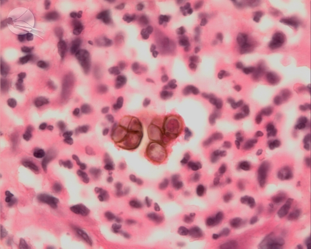 EAnofel's tweet photo. 🍄Picture of the day: Skin biopsy revealing muriform cells (also called "copper pennies" or fumagoids cells) under the🔬. #chromoblastomycosis. Interested in pictures of other fungal diseases ? 👉Register to eanofel (https://t.co/oJFxGyrjhh). #thinkfungus https://t.co/FR5rXKK5a9