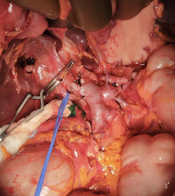 AmarGuptaMD (@amargupta_md) on Twitter photo Total pancreatectomy with islet-auto transplant. <a href="/bswhealth_DFW/">Baylor Scott & White Dallas-Fort Worth</a> is one of the nations highest volume programs in this procedure for chronic pancreatitis. With proper selection most patients can get back to normal life, many insulin-free. <a href="/AHPBA/">AHPBA</a> <a href="/ASTSChimera/">ASTS</a> <a href="/IHPBA/">IHPBA</a> <a href="/AmerGastroAssn/">American Gastroenterological Association (AGA)</a> Total pancreatectomy with islet-auto transplant. <a href="/bswhealth_DFW/">Baylor Scott & White Dallas-Fort Worth</a> is one of the nations highest volume programs in this procedure for chronic pancreatitis. With proper selection most patients can get back to normal life, many insulin-free. <a href="/AHPBA/">AHPBA</a> <a href="/ASTSChimera/">ASTS</a> <a href="/IHPBA/">IHPBA</a> <a href="/AmerGastroAssn/">American Gastroenterological Association (AGA)</a>