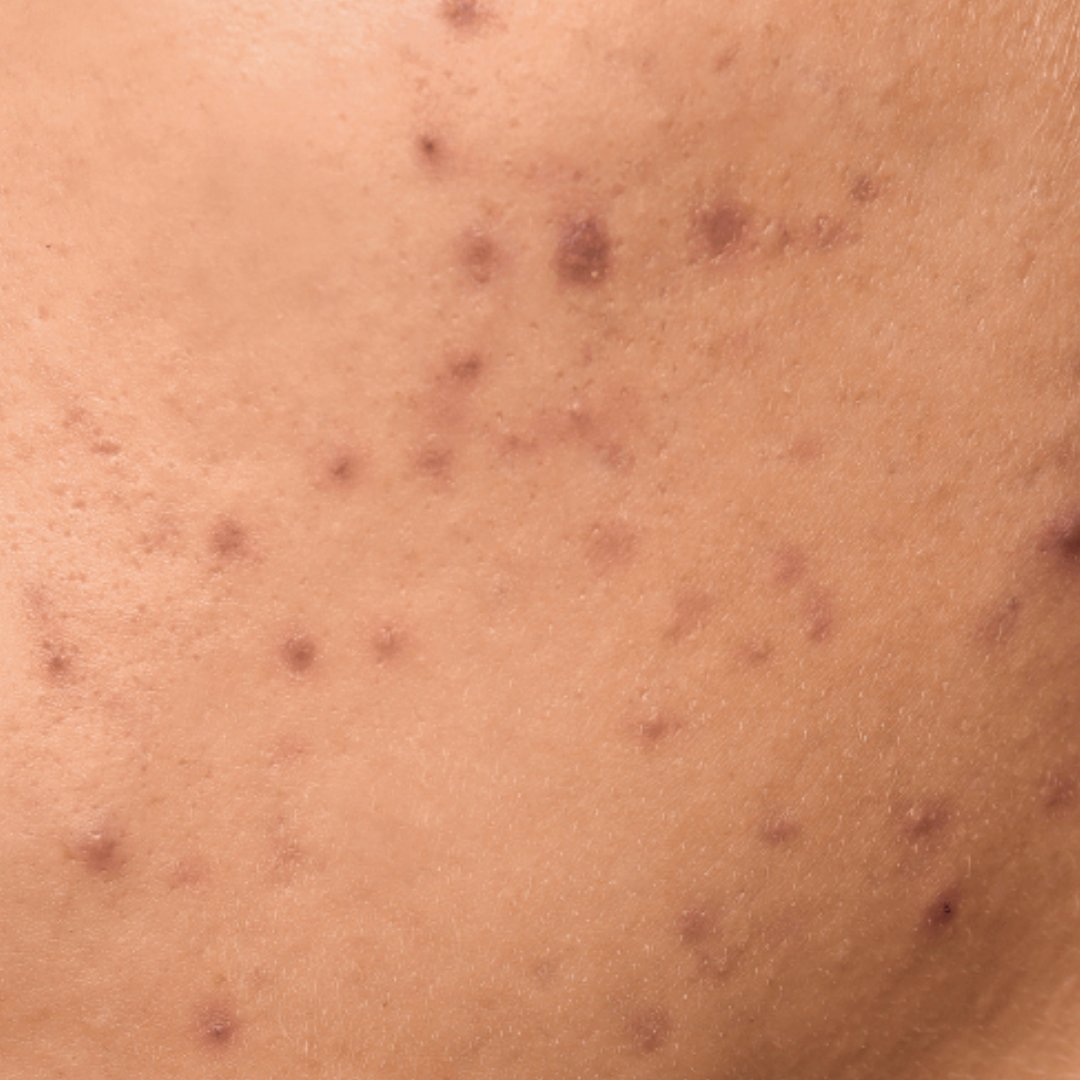 msbb_id's tweet photo. "Min, cara ngatasin dark spot/bekas jerawat supaya tampilannya lebih sopan gimana ya?”

Oke, kali ini mimin peri bakal berbagi tips untuk membantu permasalahan dark spot sekaligus rekomendasi produk racunnya🧚🏻‍♀️

Simak thread ini sampai selesai ya!😉 https://t.co/yj56gYg3gr